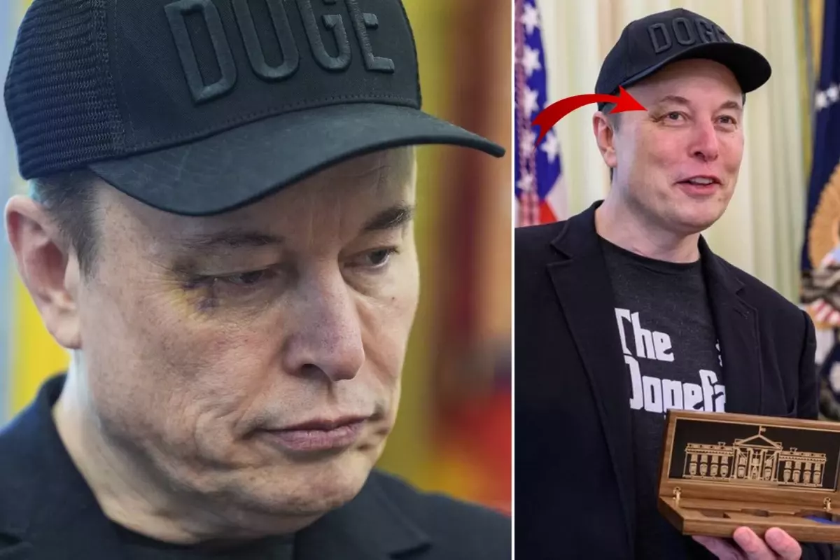 Elon Musk'ın Gözündeki Morluk Hakkında Şok İddia