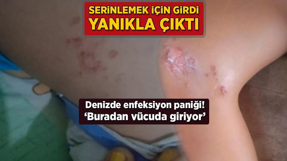 Antalya Selinus Sahili'nde Deniz Enfeksiyonu Paniği: 9 Yaşındaki Çocuk Hastaneye Kaldırıldı